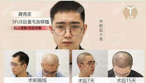 <!--<i data=20240705-sp></i>-->植发前后对比照