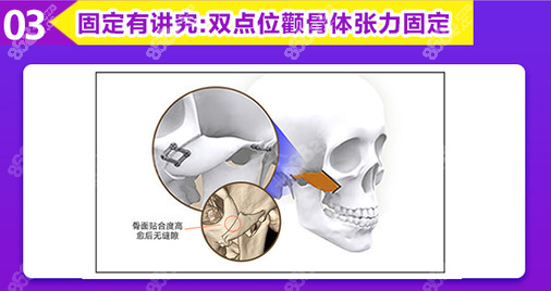 双点位颧骨体张力固定