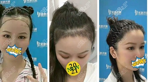 重庆<!--<i data=20240705-sp></i>-->植发前后对比照