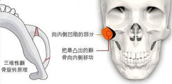 沈绍勇院长颧骨磨骨手术示意图