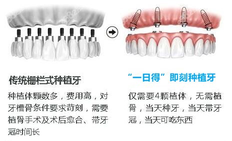 “一日得”即刻种植牙技术：4颗植体种半口牙