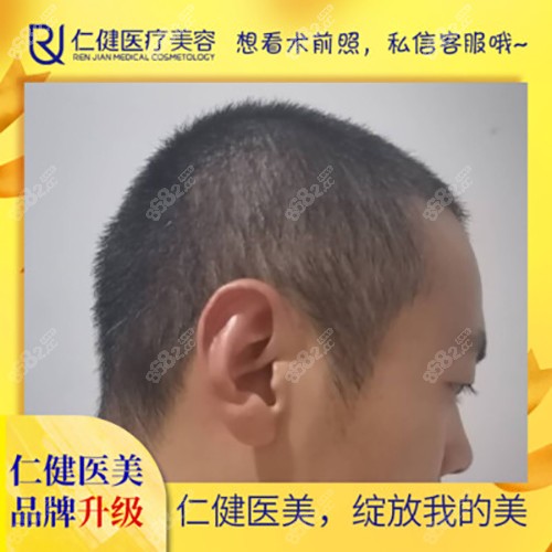 广州仁健植发微针植发后照片