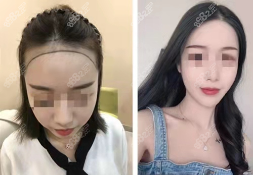 西安沐森植发对比照