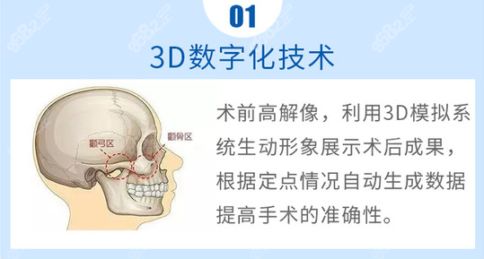 3D数字化技术辅助颧骨手术