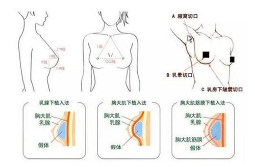 毋巨龙隆胸技术