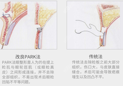 park法和普通双眼皮的差别