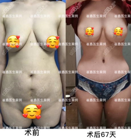 西安国 际崔鑫腹壁成形+巨乳缩小范例