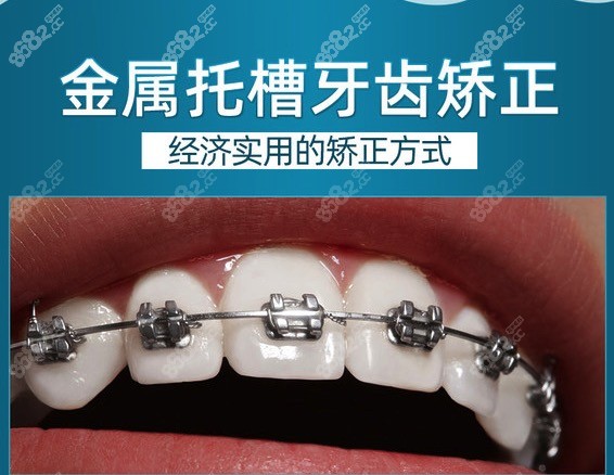 金属托槽矫正牙齿