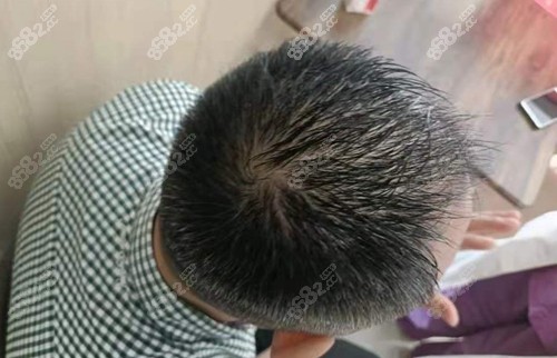 <!--<i data=20240705-sp></i>-->术后三个月的样子
