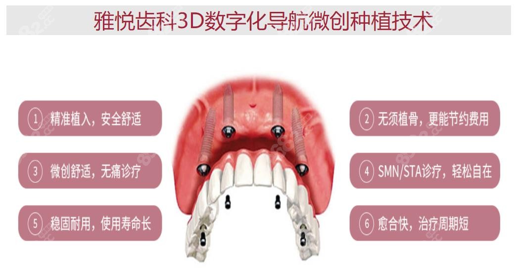 雅悦齿科3D数字化导航微创种植技术