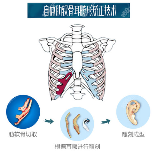 自体肋软骨耳再造手术方式