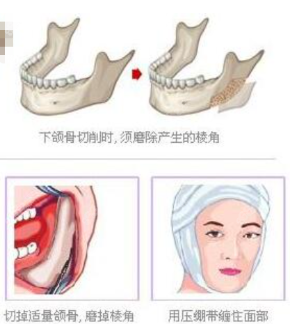 <!--<i data=20240705-sp></i>-->下颌角整形技术----下颌角外板磨骨