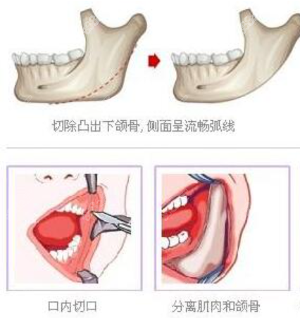 <!--<i data=20240705-sp></i>-->下颌角整形技术----下颌角切除