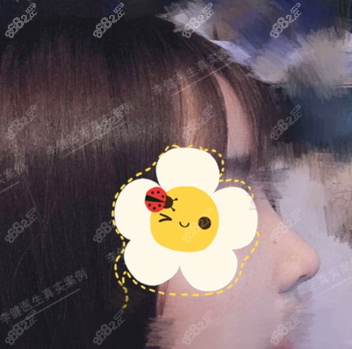 上海华美李健隆鼻术后图片