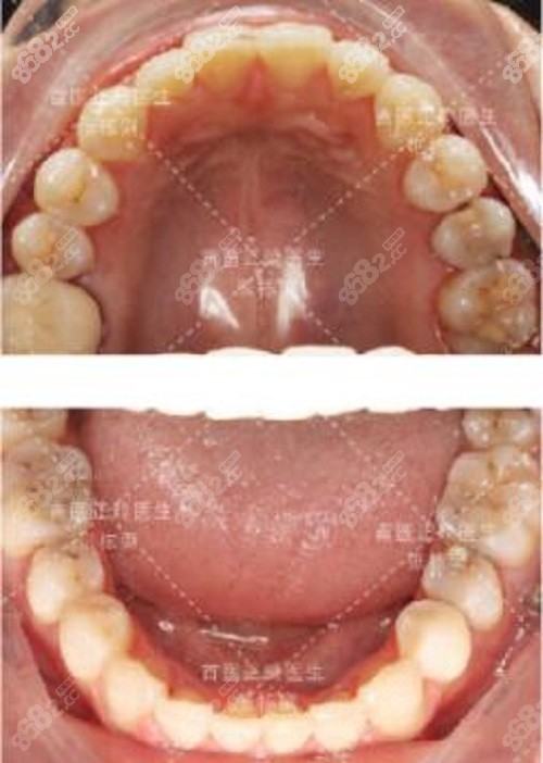 北京禾禾张栋梁医生不拔牙矫正术后牙齿图