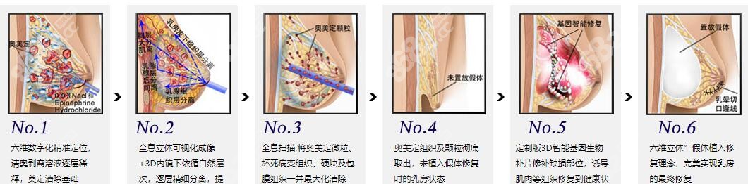 全息六维层离清奥术手术流程