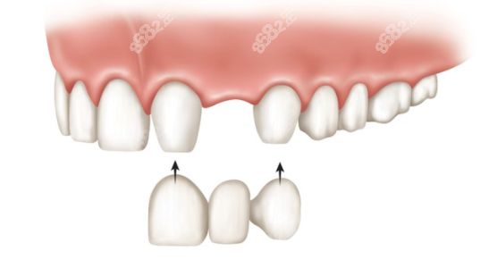 镶牙示意图