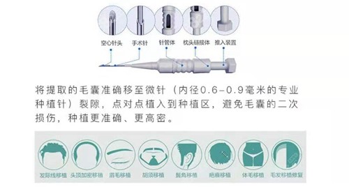 珠海艾瑞植发优势