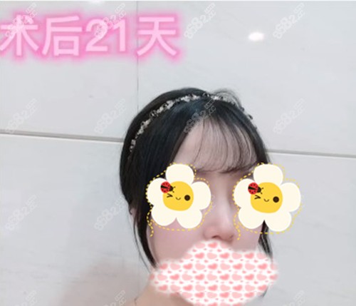 李健隆鼻术后21天照片