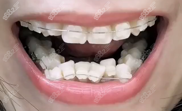 银川牙齿矫正