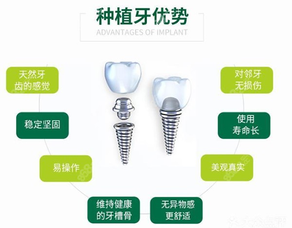 北京美冠塔口腔的种牙优势