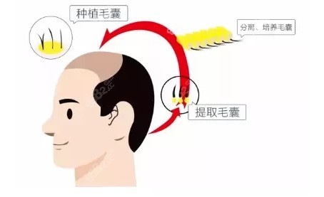 北京联合丽格种植头发过程和步骤