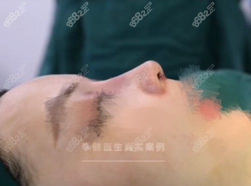 李健做鼻修复术后即刻