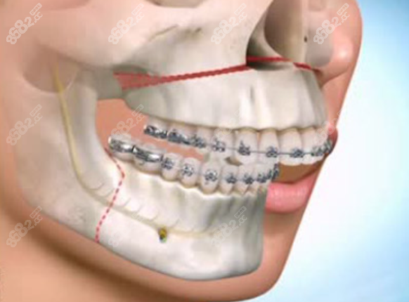 正畸正颌联合治疗
