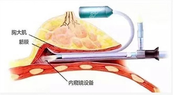 精细内窥可视技术