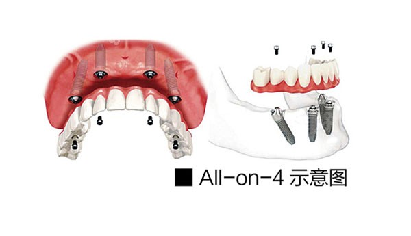 上海维佳康口腔allon4