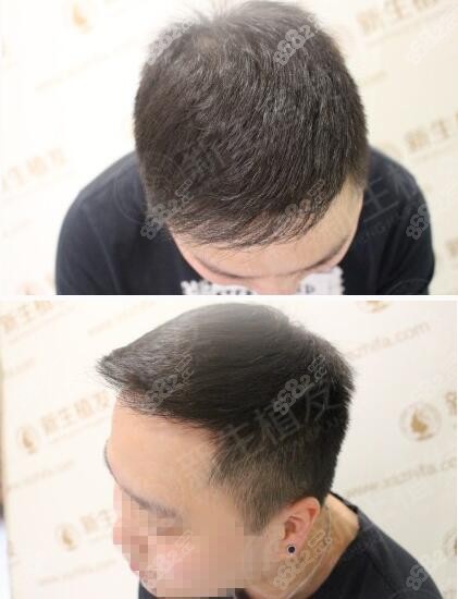 <!--<i data=20240705-sp></i>-->植发术后9个月