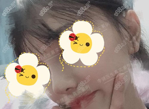 上海华美李健隆鼻术后图
