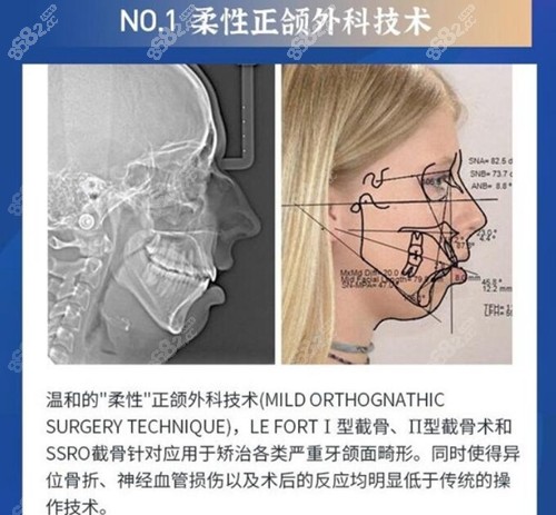 重庆北部宽仁医院柔性正颌手术介绍