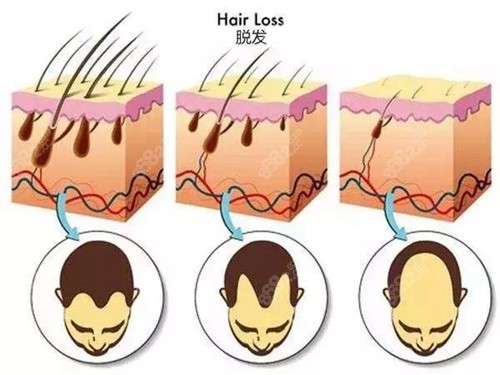 脱发过程科普图