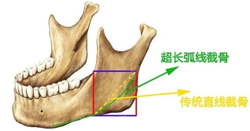 <!--<i data=20240705-sp></i>-->做下颌角手术技术