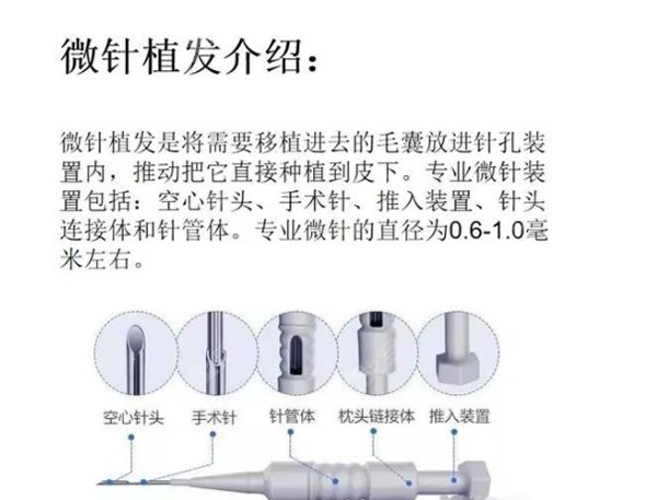 北京联合丽格微针植发怎么样