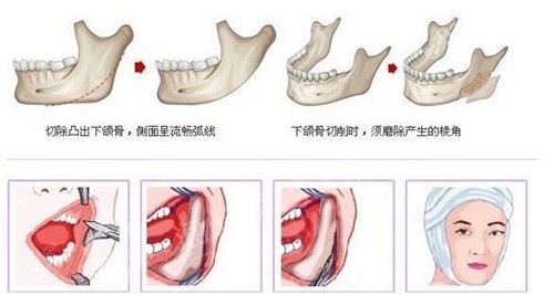 上海愉悦美联臣磨骨削骨科普示意图