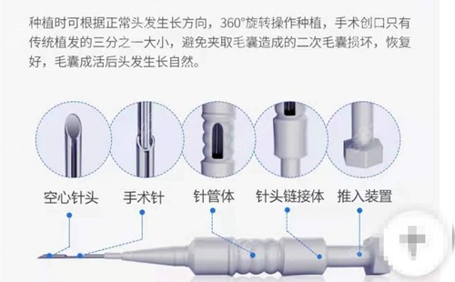 西安大麦微针植发技术优势