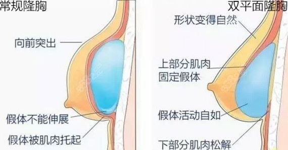 上海华美双平面隆胸