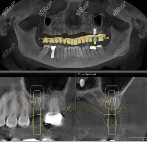张家港珂润口腔种植牙CT