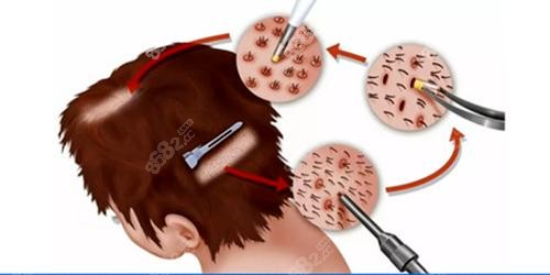 天津<!--<i data=20240705-sp></i>-->种植毛发医院移植毛发