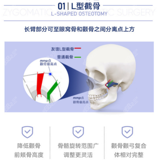 磨颧骨手术示意图