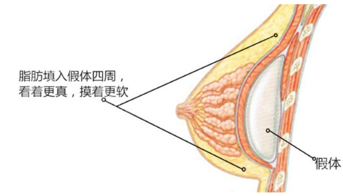 自体脂肪和假体复合隆胸