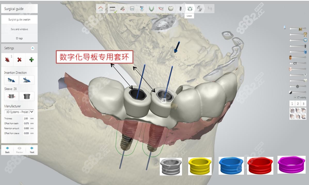 和仁堂牙科数字化种植导板技术