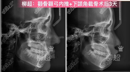 广州广大柳超磨骨CT