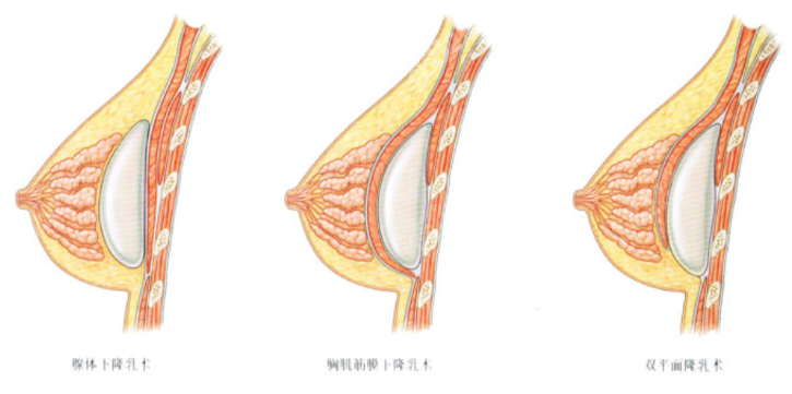 特贝茨双平面隆胸