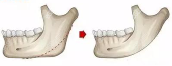 上海华美下颌角整形