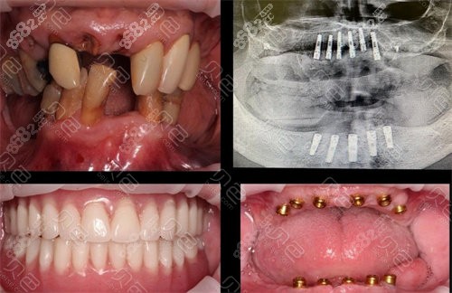 上虞锡荣口腔种植牙对比