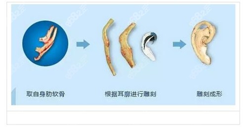 自体肋软骨雕刻耳朵