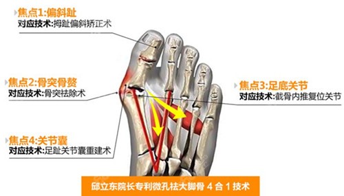 北京圣嘉新邱立东做大脚骨